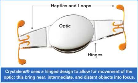 Implante de lentillas para vision HD