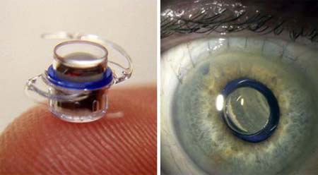 "VisionCare" un implante para el ojo